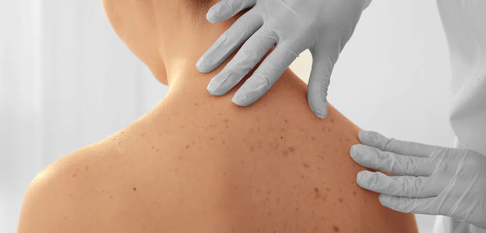 Prevenção e cuidados no câncer de pele melanoma - muito além da atenção na exposição ao sol